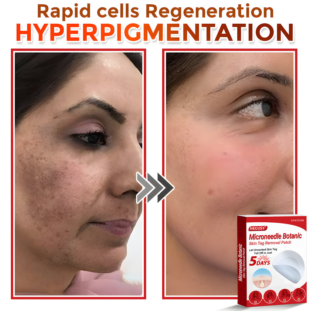 ✅Negusy™ MicroNeedle Botanic Skin Tag Removal Patches – 🇺🇸 Made in the USA | Fast, Painless, Plant-Powered