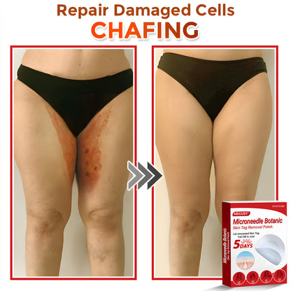 ✅Negusy™ MicroNeedle Botanic Skin Tag Removal Patches – 🇺🇸 Made in the USA | Fast, Painless, Plant-Powered