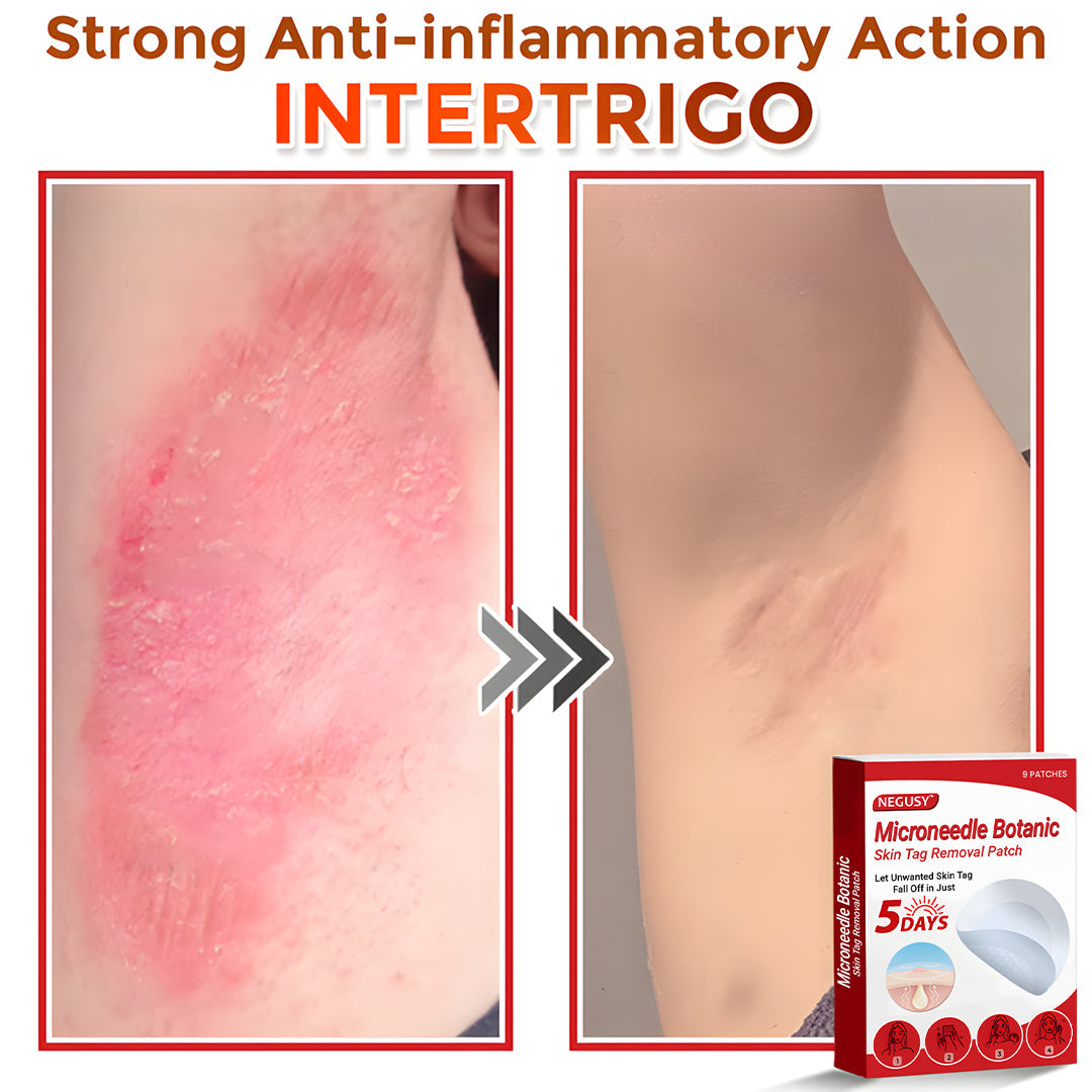 ✅Negusy™ MicroNeedle Botanic Skin Tag Removal Patches – 🇺🇸 Made in the USA | Fast, Painless, Plant-Powered