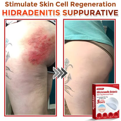 ✅Negusy™ MicroNeedle Botanic Skin Tag Removal Patches – 🇺🇸 Made in the USA | Fast, Painless, Plant-Powered