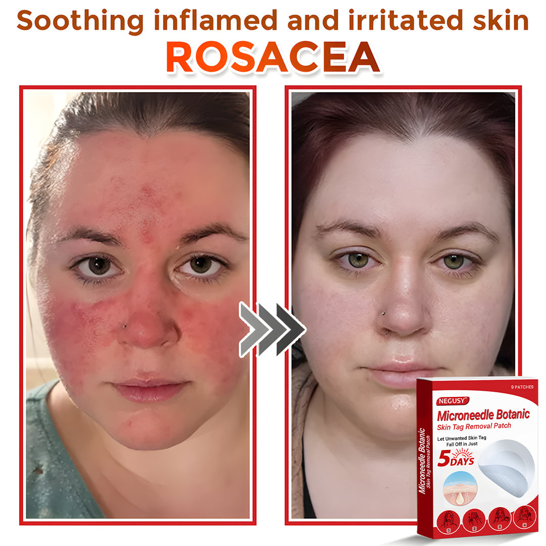 ✅Negusy™ MicroNeedle Botanic Skin Tag Removal Patches – 🇺🇸 Made in the USA | Fast, Painless, Plant-Powered