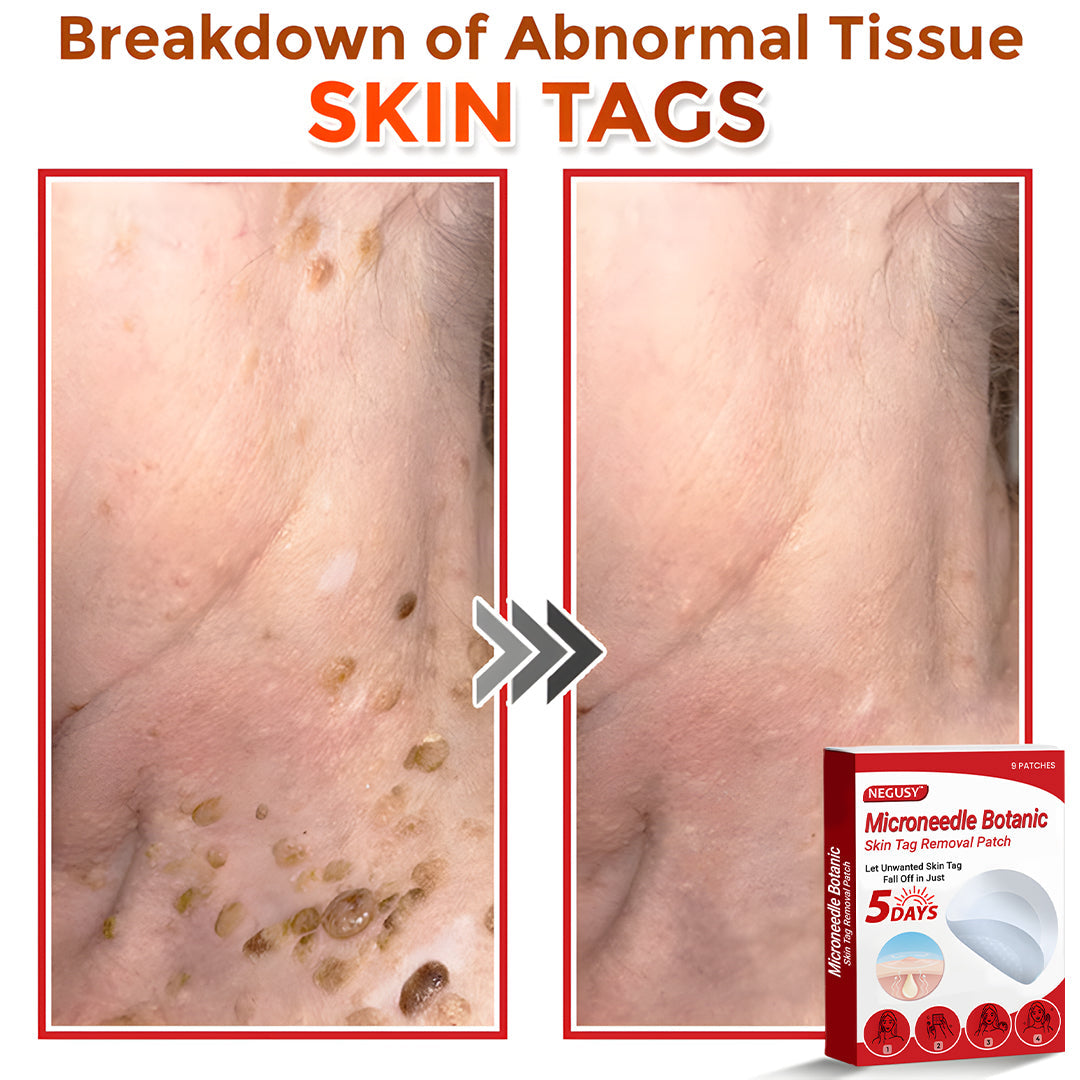 ✅Negusy™ MicroNeedle Botanic Skin Tag Removal Patches – 🇺🇸 Made in the USA | Fast, Painless, Plant-Powered