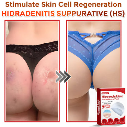 ✅Negusy™ MicroNeedle Botanic Skin Tag Removal Patches – 🇺🇸 Made in the USA | Fast, Painless, Plant-Powered