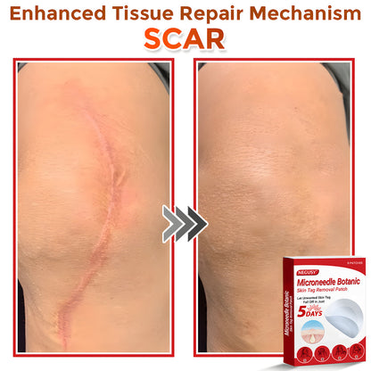 ✅Negusy™ MicroNeedle Botanic Skin Tag Removal Patches – 🇺🇸 Made in the USA | Fast, Painless, Plant-Powered