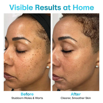 Seurico™ Laser Pen – Non-Invasive Mole and Wart Removal 1–3 days